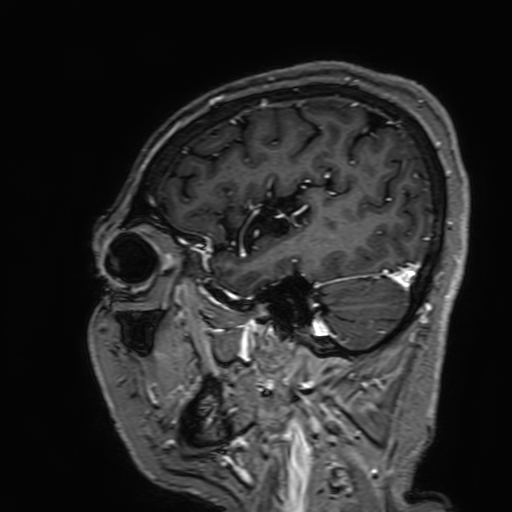 Cavernous hemangioma of the cerebellar falx (Radiopaedia 73025-83724 Sagittal T1 C+ 45).jpg