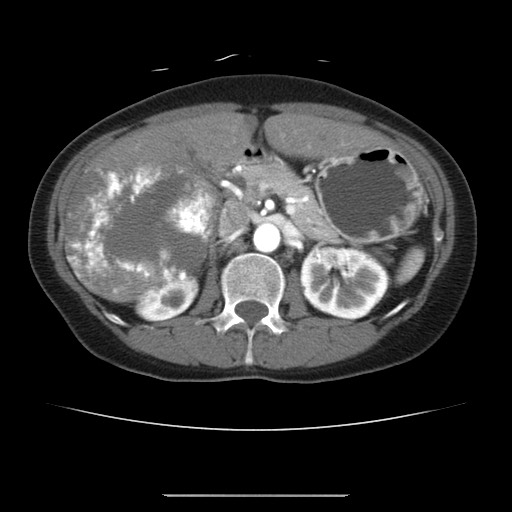 Cavernous hepatic hemangioma (Radiopaedia 75441-86667 A 41).jpg