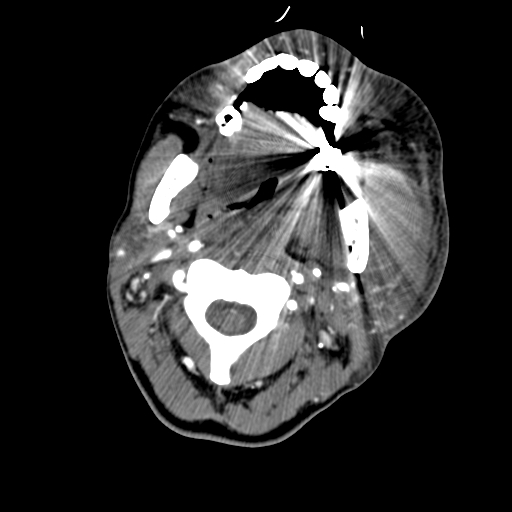 File:Cavernous sinus thrombosis (Radiopaedia 10619-11078 A 13).jpg