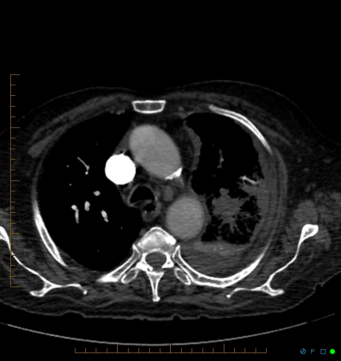 Cavitating pulmonary infarction (Radiopaedia 54634-60849 Axial C+ CTPA 17).jpg
