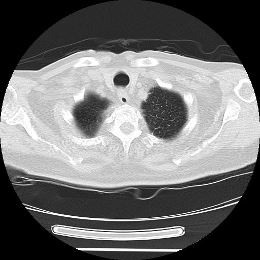 Cavitating pulmonary metastases (Radiopaedia 89545-106544 Axial lung window 5).jpg