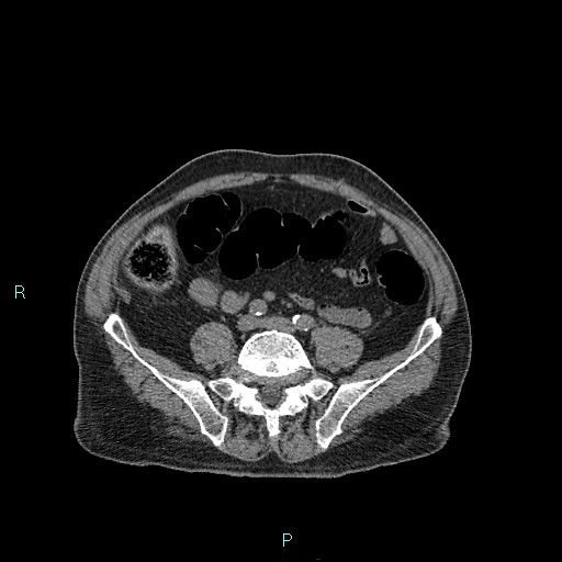 Cecal bascule (Radiopaedia 85770-101586 Axial non-contrast 72).jpg