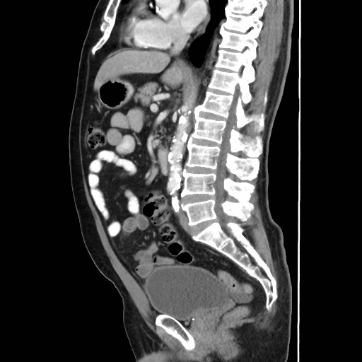 Cecal mass causing appendicitis (Radiopaedia 59207-66531 C 33).jpg