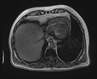 Cecal mass causing appendicitis (Radiopaedia 59207-66532 D 23).jpg