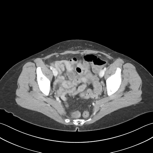 Cecum hernia through the foramen of Winslow (Radiopaedia 46634-51112 A 63).png