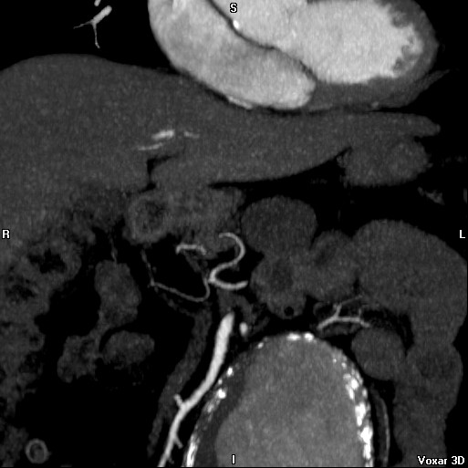 File:Celiac artery anatomy (Radiopaedia 16763-16476 A 1).jpg