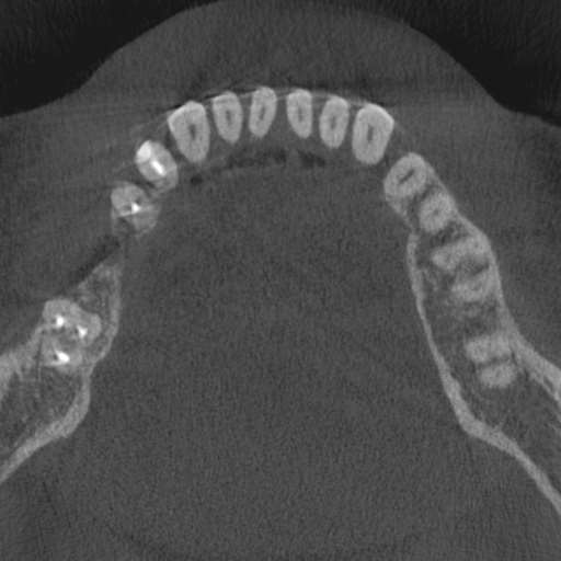 Cemento-osseous dysplasia (Radiopaedia 48251-53126 Axial non-contrast 46).jpg