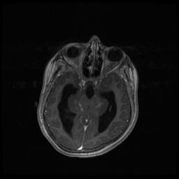 Central neurocytoma (Radiopaedia 30220-30842 Axial T1 C+ 58).jpg