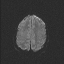 Central neurocytoma (Radiopaedia 56690-63469 Axial DWI 55).jpg