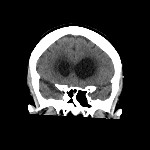File:Central neurocytoma (Radiopaedia 65317-74346 Coronal non-contrast 21).png