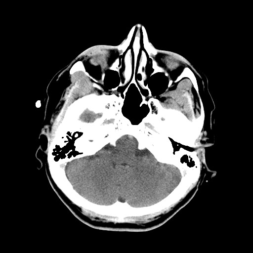 File:Central neurocytoma (Radiopaedia 68725-78432 Axial C+ 10).jpg
