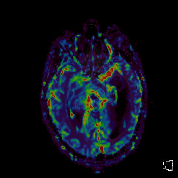Central neurocytoma (Radiopaedia 84497-99872 Axial Perfusion 187).jpg