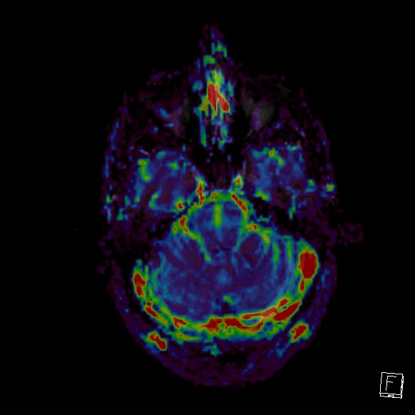 Central neurocytoma (Radiopaedia 84497-99872 Axial Perfusion 225).jpg