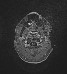 Central neurocytoma (Radiopaedia 84497-99872 Axial T1 C+ 4).jpg