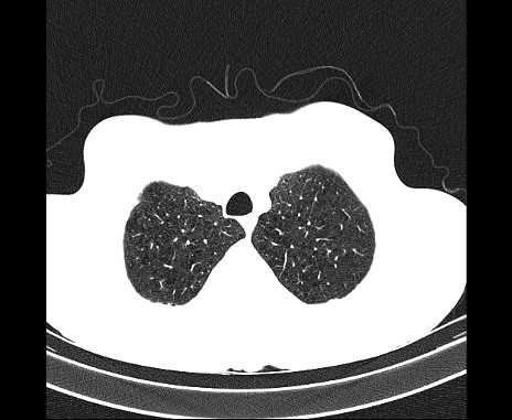 Centrilobular pulmonary emphysema (Radiopaedia 62468-70718 Axial lung window 11).jpg