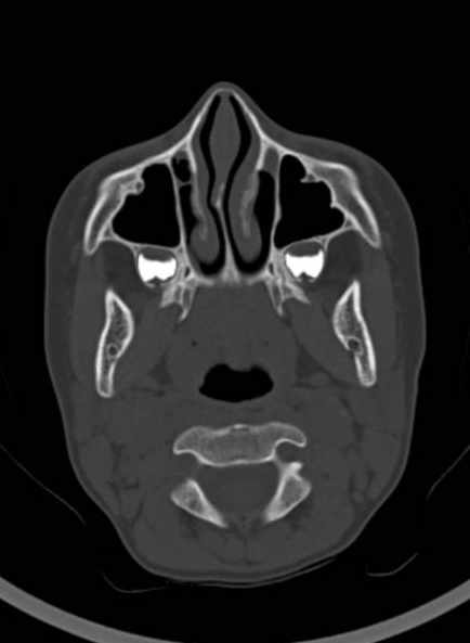 Cerebellar abscess (Radiopaedia 73727-84527 Axial bone window 12).jpg