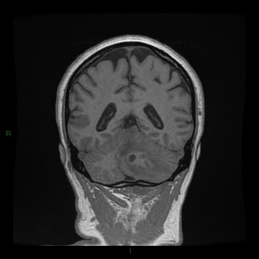 File:Cerebellar abscess (Radiopaedia 78135-90678 Coronal T1 C+ 115).jpg