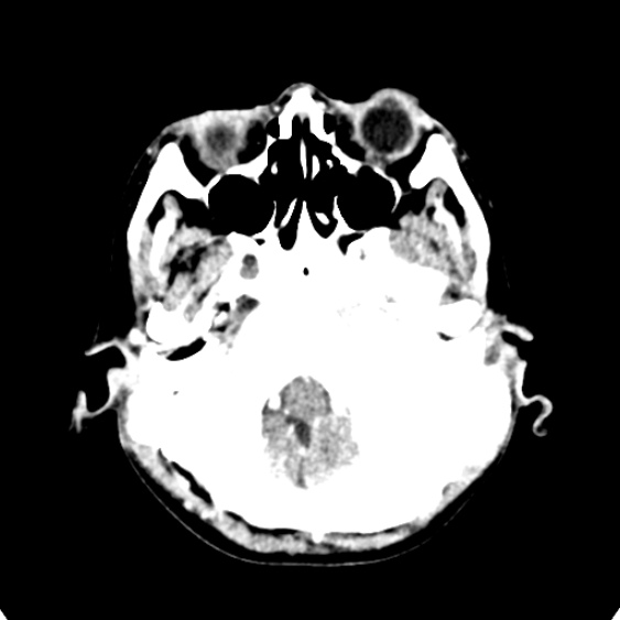 Cerebellar abscess secondary to mastoiditis (Radiopaedia 26284-26412 Axial C+ delayed 18).jpg