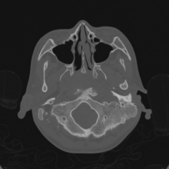 File:Cerebellar abscess secondary to mastoiditis (Radiopaedia 26284-26413 Axial bone window 22).jpg