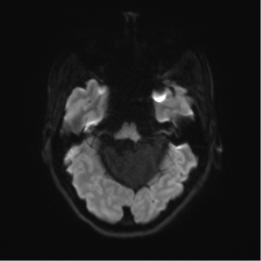 Cerebellar agenesis with hypoplastic pons (pontocerebellar hypoplasia) (Radiopaedia 57224-64138 Axial DWI 48).png