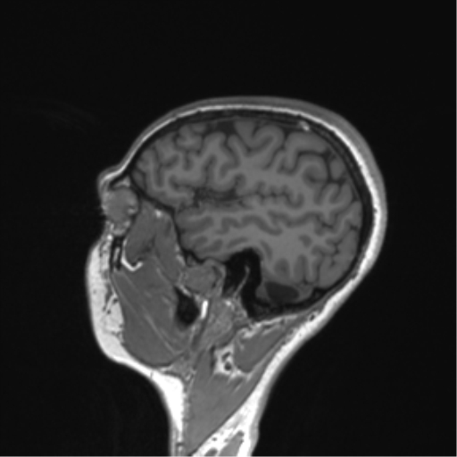 File:Cerebellar agenesis with hypoplastic pons (pontocerebellar hypoplasia) (Radiopaedia 57224-64138 Sagittal T1 19).png