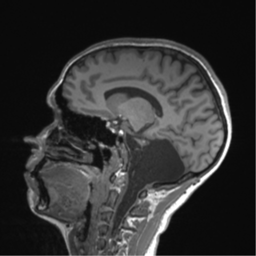 Cerebellar agenesis with hypoplastic pons (pontocerebellar hypoplasia) (Radiopaedia 57224-64138 Sagittal T1 32).png