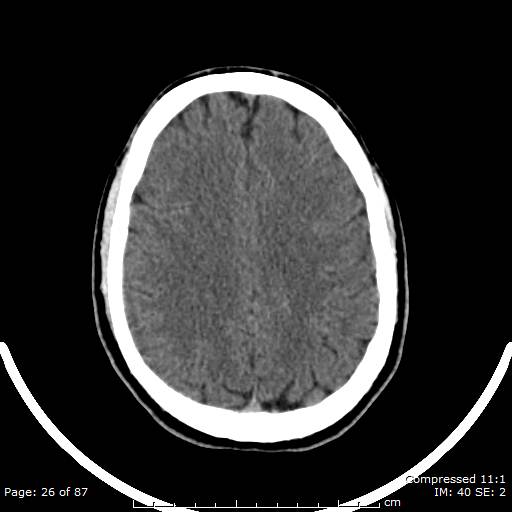 Cerebellar hemangioblastoma (Radiopaedia 52360-58258 Axial non-contrast 26).jpg