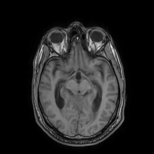 File:Cerebellar hemangioblastoma (Radiopaedia 88055-104622 Axial T1 17).jpg