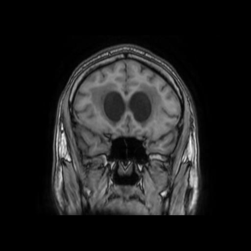 File:Cerebellar hemangioblastoma (Radiopaedia 88055-104622 Coronal T1 12).jpg