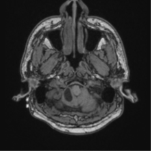 Cerebellar hemangioblastomas and pituitary adenoma (Radiopaedia 85490-101176 Axial T1 8).png