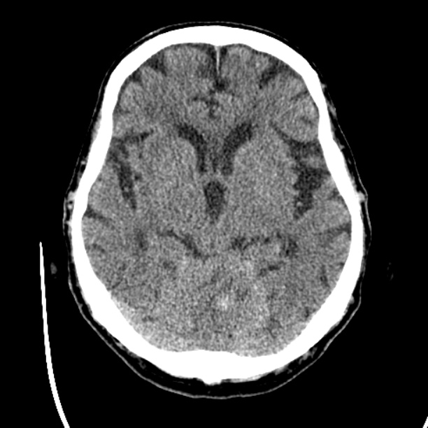 Cerebellar hemorrhage (Radiopaedia 27193-27359 Axial non-contrast 21).jpg