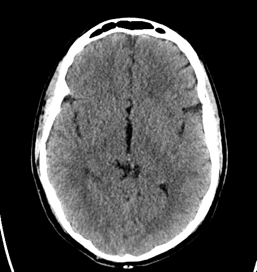 File:Cerebellar infarct due to vertebral artery dissection with posterior fossa decompression (Radiopaedia 82779-97031 Axial non-contrast 15).png