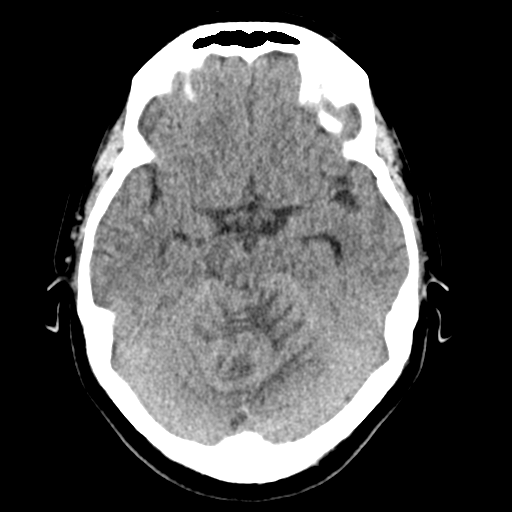 Cerebellar metastasis (Radiopaedia 54578-60812 Axial non-contrast 18).png