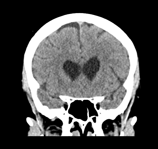 Cerebellar metastasis (Radiopaedia 54578-60812 Coronal non-contrast 19).png