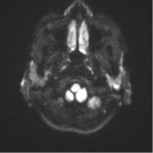 Cerebellar metastasis - adenocarcinoma lung (Radiopaedia 63184-71715 Axial DWI 30).png