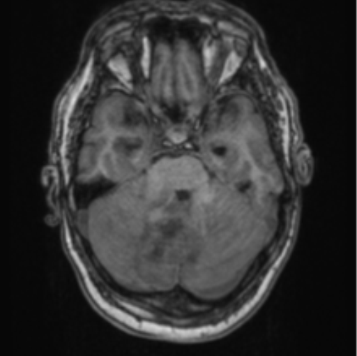 Cerebellar metastasis from lung adenocarcinoma (Radiopaedia 86690-102829 Axial T1 27).png