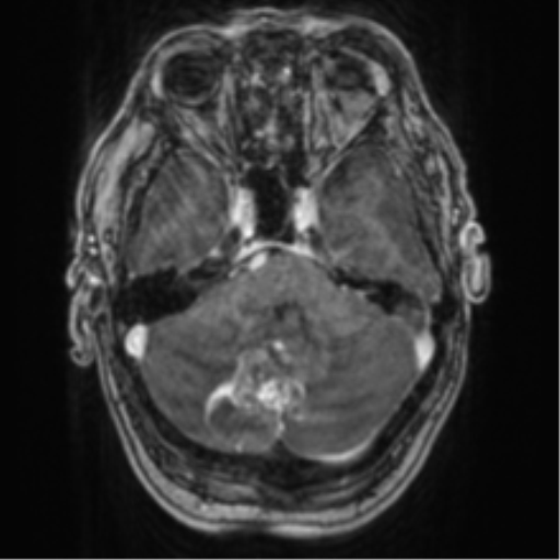File:Cerebellar metastasis from lung adenocarcinoma (Radiopaedia 86690-102829 Axial T1 C+ 24).png