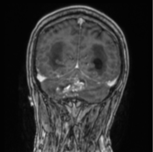 Cerebellar metastasis from lung adenocarcinoma (Radiopaedia 86690-102829 Coronal T1 C+ 25).png