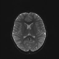 File:Cerebellar stroke (Radiopaedia 32202-33150 Axial DWI 14).png