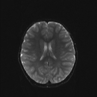 File:Cerebellar stroke (Radiopaedia 32202-33150 Axial DWI 15).png