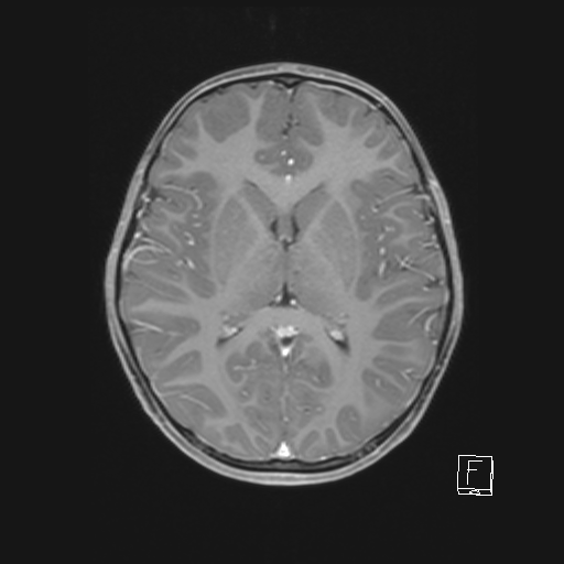 File:Cerebellar stroke (Radiopaedia 32202-33150 Axial T1 C+ 41).png