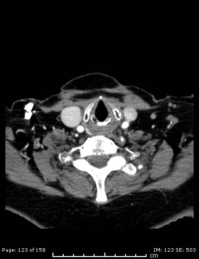 File:Cerebellar strokes due to intracranial giant cell arteritis (Radiopaedia 68799-78510 CT angiogram 123).jpg