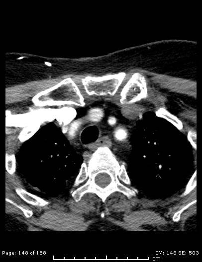 Cerebellar strokes due to intracranial giant cell arteritis (Radiopaedia 68799-78510 CT angiogram 148).jpg
