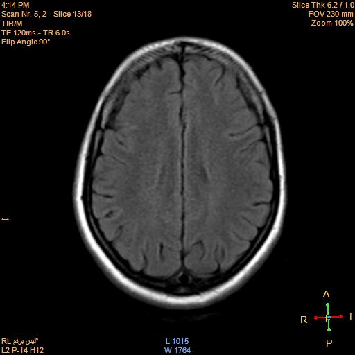 File:Cerebellopontine angle meningioma (Radiopaedia 22488-22525 Axial FLAIR 12).jpg