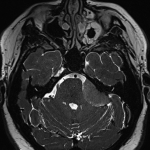 Cerebellopontine angle meningioma (Radiopaedia 48434-53348 Axial T2 Space 67).png