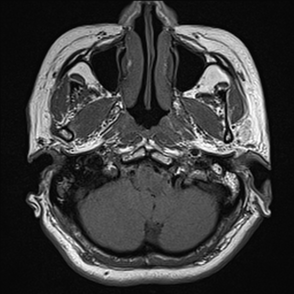 File:Cerebellopontine angle meningioma (Radiopaedia 53561-59591 Axial T1 3).jpg