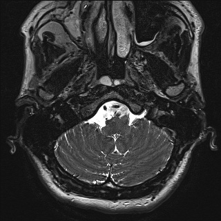 Cerebellopontine angle meningioma (Radiopaedia 72983-83680 Axial FIESTA 3).jpg