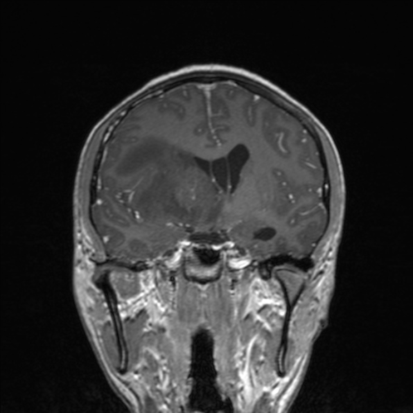 Cerebral abscess (Radiopaedia 24212-24478 Coronal T1 C+ 102).jpg