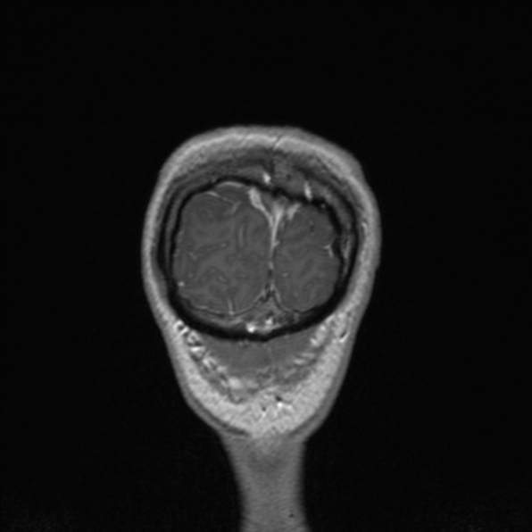 Cerebral abscess (Radiopaedia 24212-24478 Coronal T1 C+ 186).jpg