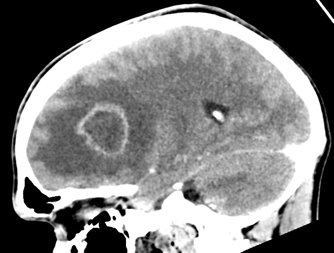 Cerebral abscess (Radiopaedia 60342-68008 Sagittal C+ delayed 32).png